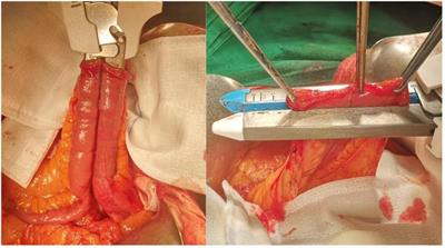 Novel heterotopic continental ileal reservoir based on the Mitrofanoff principle: a case report and review of the literature